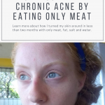 How I Cured my chronic acne by eating only meat